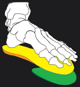 Forefoot ITS wedge
